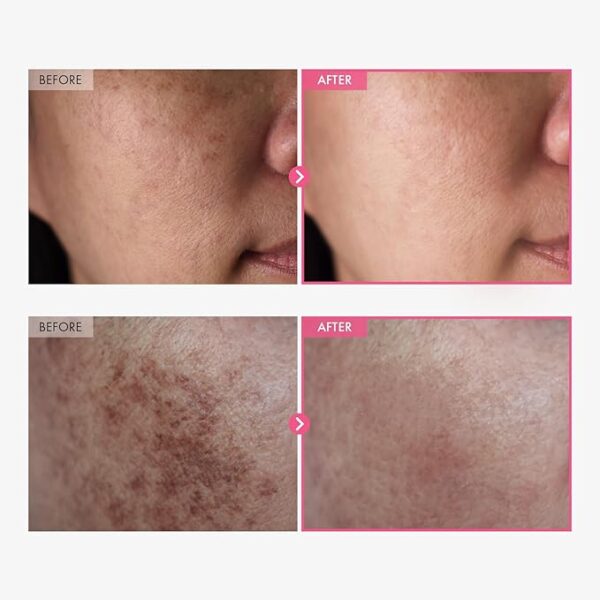 -30%OFF Arbutin 7% + Tranexamic Acid 4% Cream, 70,000ppm Arbutin, - Image 2